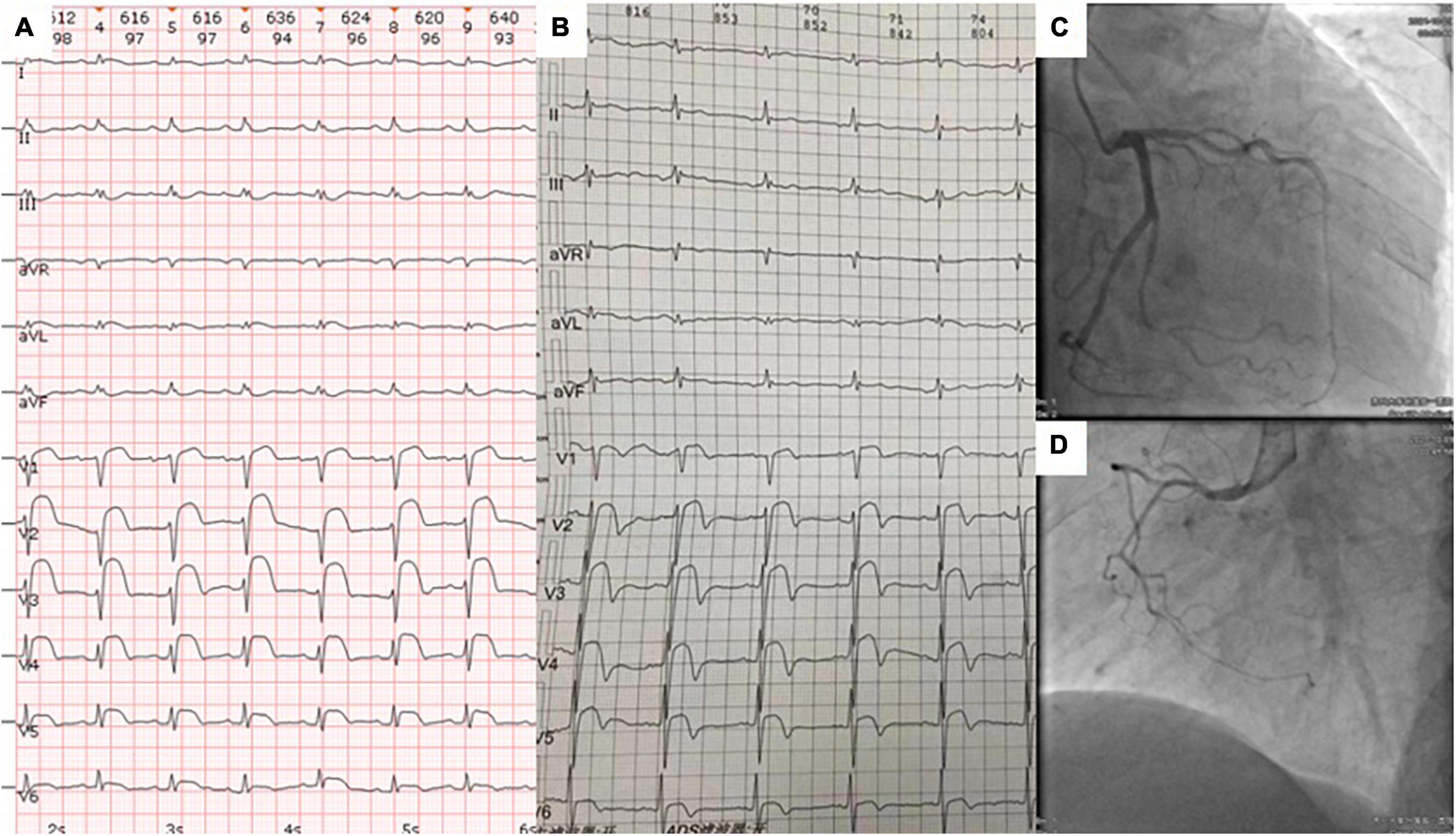 Case report: Persistent ST-segment elevation due to cardiac metastasis from lung cancer